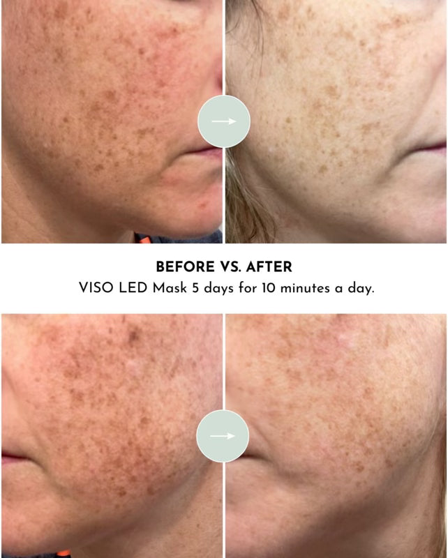 VISO Red Light Therapy Mask – view 10